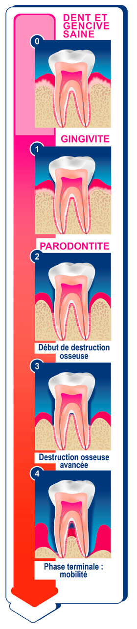 maladie parodontale