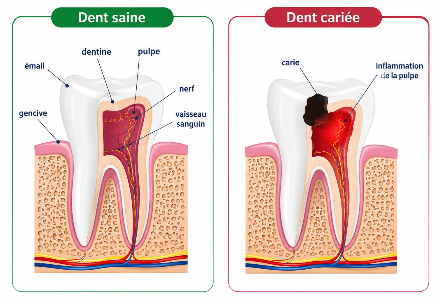 Schéma comparatif d’une dent saine et d’une dent cariée, avec émail, dentine, pulpe, nerf et gencive
