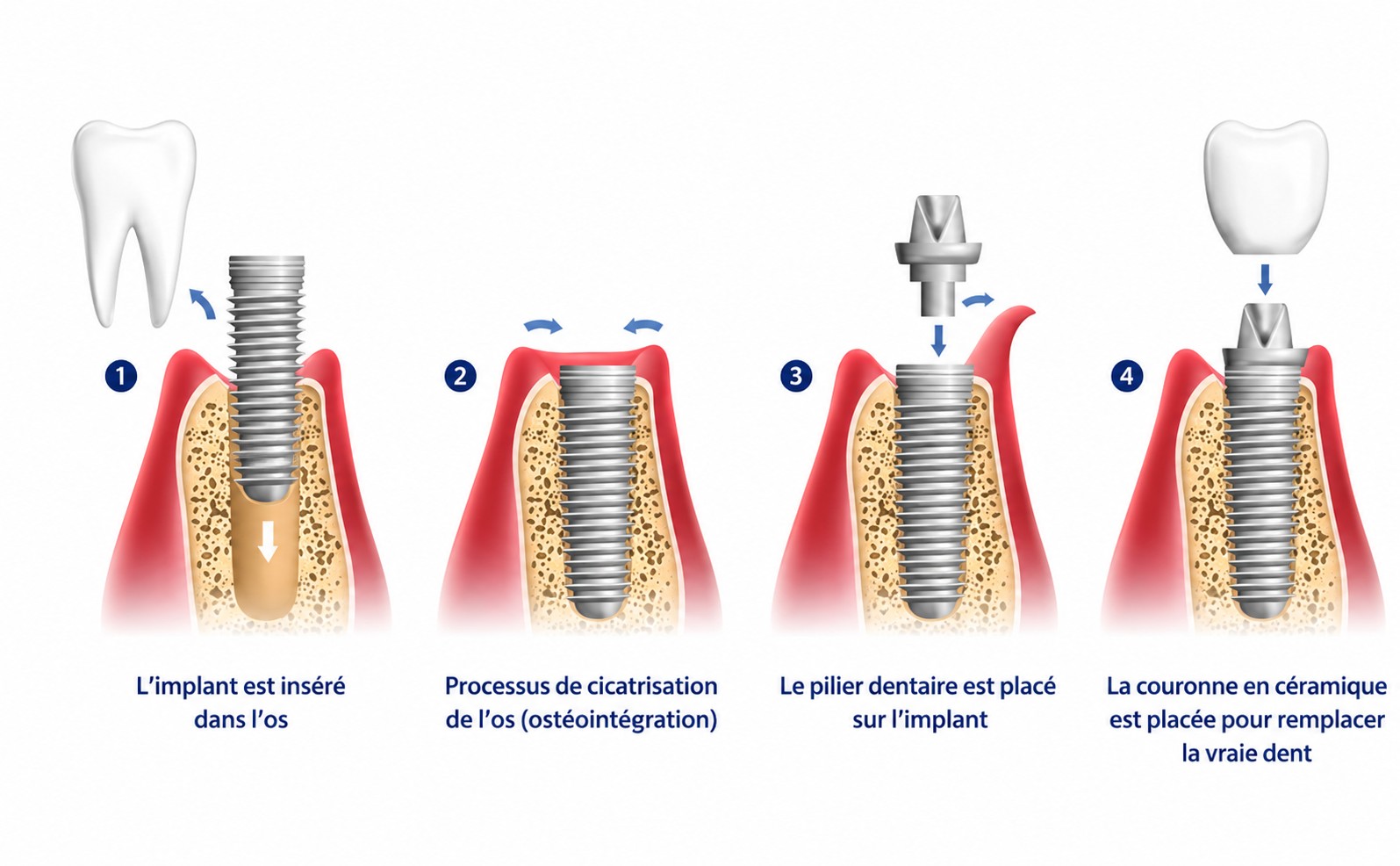 Les 4 étapes de la pose d’un implant dentaire : insertion, ostéointegration, pilier, couronne céramique